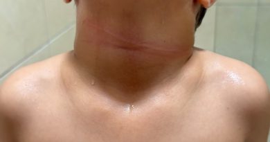 Menino escapa de tragédia após ser atingido por linha com cerol em Parnaíba