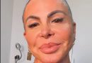 Gretchen atualiza fãs após transplante capilar e mostra recuperação: “Estou bem”