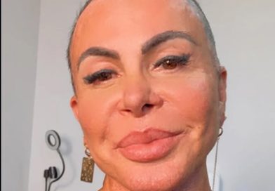 Gretchen atualiza fãs após transplante capilar e mostra recuperação: “Estou bem”