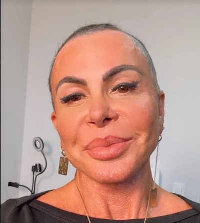 Gretchen atualiza fãs após transplante capilar e mostra recuperação: “Estou bem”